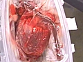 Revolution in Heart Transplant Procedure