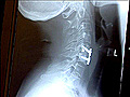 Innovations in Spine Care