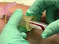 Some tips on venous blood samples