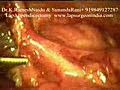 Laparoscopy Appendicectomy Video -3 (Keyhole / Lap...