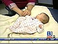 Baby Treated for Cleft Palate at Eastman in Rochester