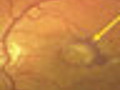 New Macular Degeneration Drugs