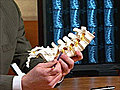 Minimally Invasive Treatment for Spinal Stenosis