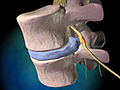 What Is Degenerative Disc Disease?