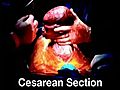 Why Choose to Perform a Cesarean