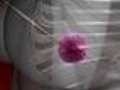 Seeds Spot Breast Tumors
