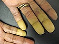 What is Raynaud’s syndrome?