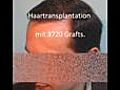 Haartransplantation mit 3720 Grafts & Ergebnis über