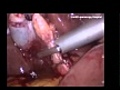 Laparoscopic Cholecystectomy HD Medical Video
