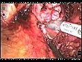 Robotic Simple Prostatectomy