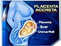 Placenta Accreta: Dangers of Multiple C-Sections