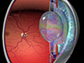 Information on Low Vision