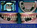 Lecture 14 - Tooth supported overdentures,  Dental Prosthodontics