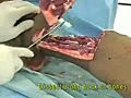 Unterhalb des Knies Amputation