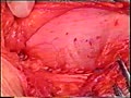 No mesh indirect hernia surgery-Desarda Repair