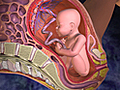 What Happens During Placenta Abruptio?