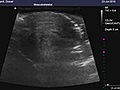 Transverse View of Axial Compression of Lumbar