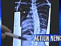 HealthCheck: Scoliosis