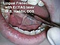 Lingual Frenektomie