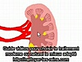calcul rénal : description et différents traitements