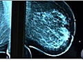 Breast Cancer Detection and Prevention