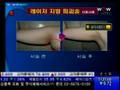 [WoW메디컬센터]BeS클리닉 S다이나믹지방파괴술 치료전후 사진