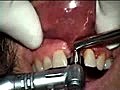 Dental Implant Failure