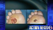 Helping to fight diabetic foot ulcers