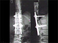Recurrent Spinal Deformity Above Spinal Fusion