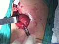 Umbilical Hernia Repair