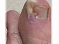 The Symptoms of Bacterial Nail Infection