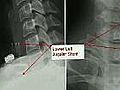 Controversial approach to treating MS