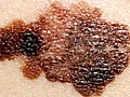 Awareness of Melanoma Cancer