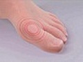 Gout: a debilitating form of arthritis