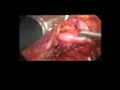 Laparoscopic Resection of Splenic Artery Aneurysm