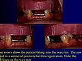 Lecture 9 - Implant-supported dentures,  Dental Prosthodontics