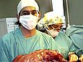 Doctors Remove Woman’s 56 Pound Tumor