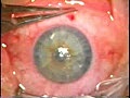 Lamellar Keratoplasty