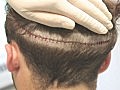 Haartransplantation: Vortrag Teil 1