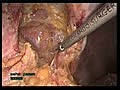 Laparoscopic Abdominal Wall Hernia Repair