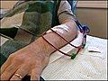 Dialysis treatment