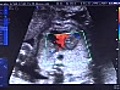 Operaciones de corazón en fetos