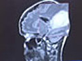 MS Treatment