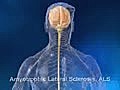 Amyotrophic lateral sclerosis 3D Animation