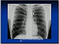 Chest X-Ray Mediastinum