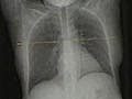 Lung cancer scans boost survival rates: study