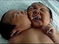 Naissance d’un enfant bicéphale en Chine