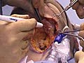 Direct Excision Cervicoplasty