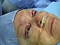 Drooping Eyelid Repair Surgery