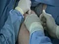 Endovenous Laser Ablation